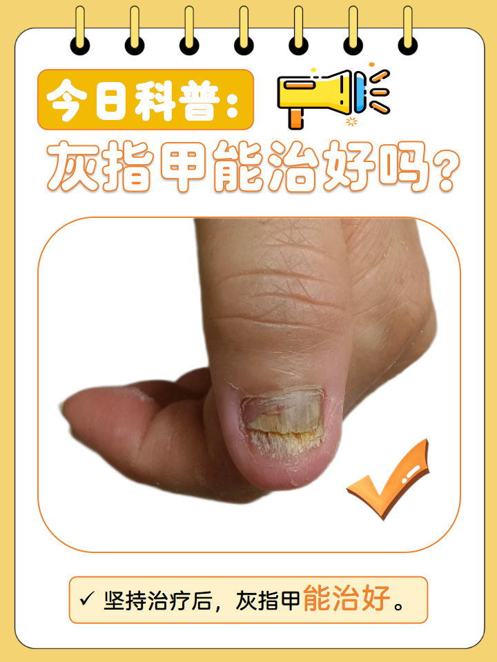"灰指甲在医学上被称为甲癣,是一种常见的皮肤疾病.