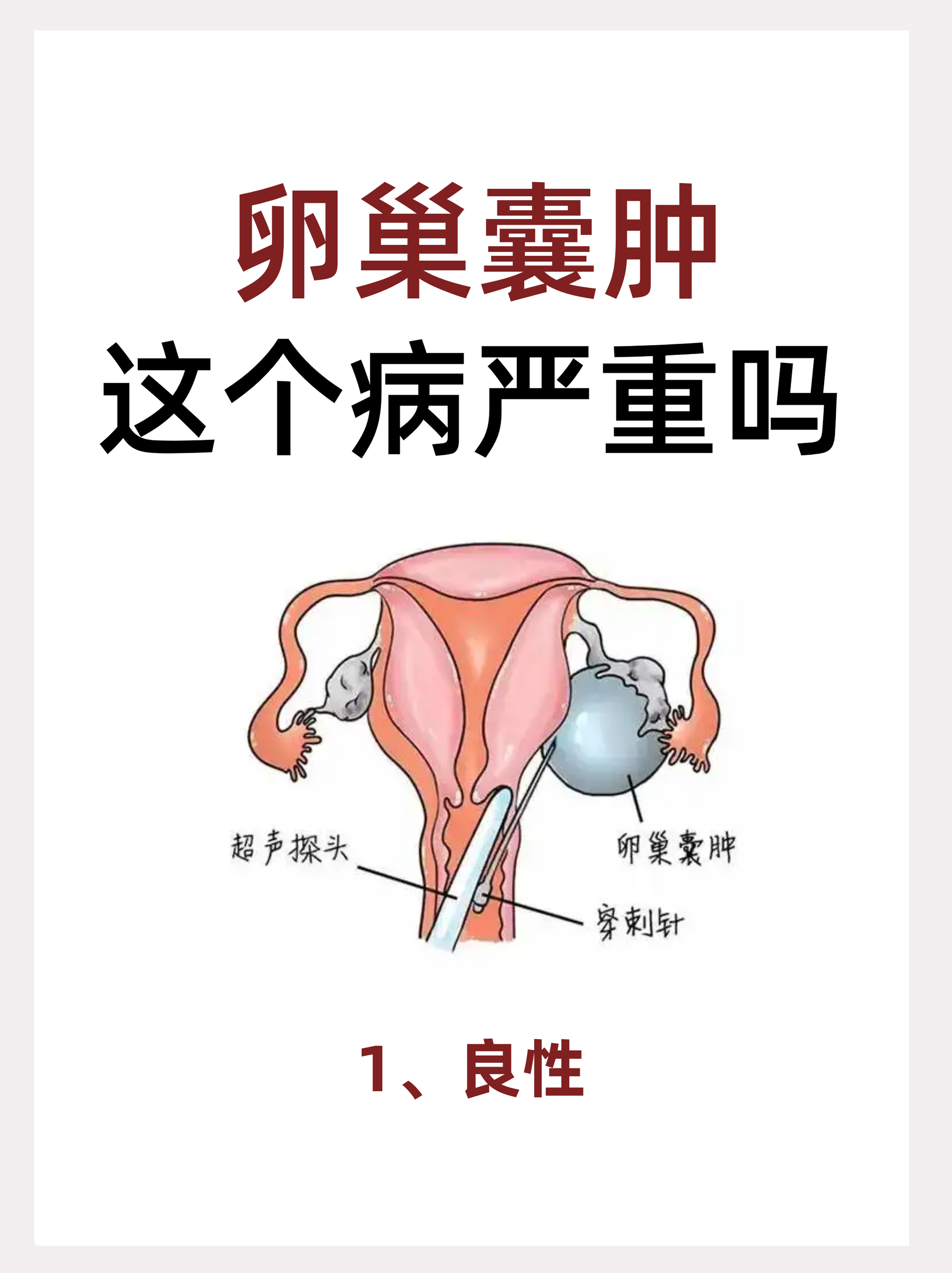 卵巢囊肿这个病严重吗 一,严重程度判断 1,良性囊肿:大多数卵巢囊肿是