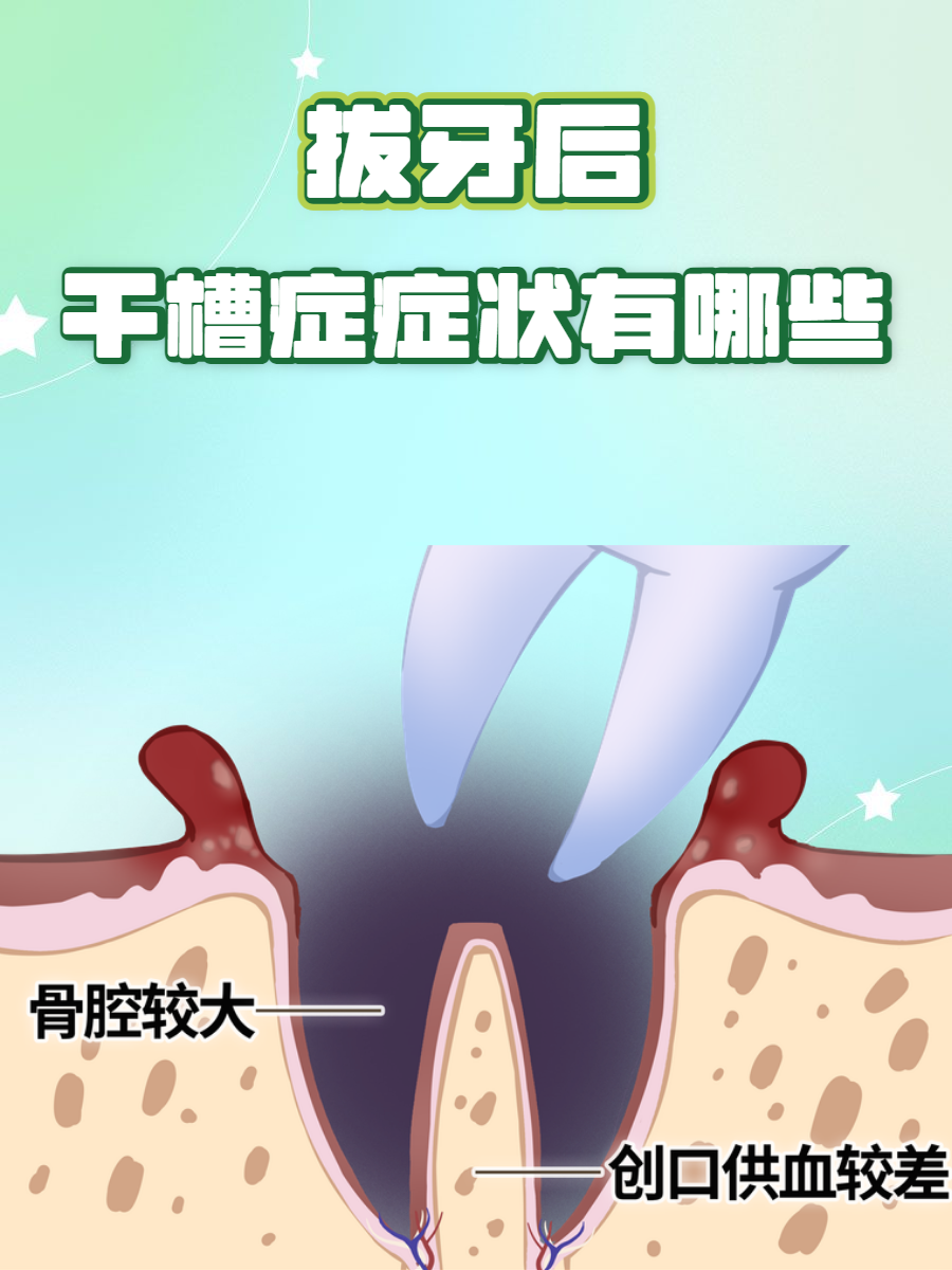 这里了解  干槽症大多为拔牙后的并发症,很多人在拔牙后担心会存在这