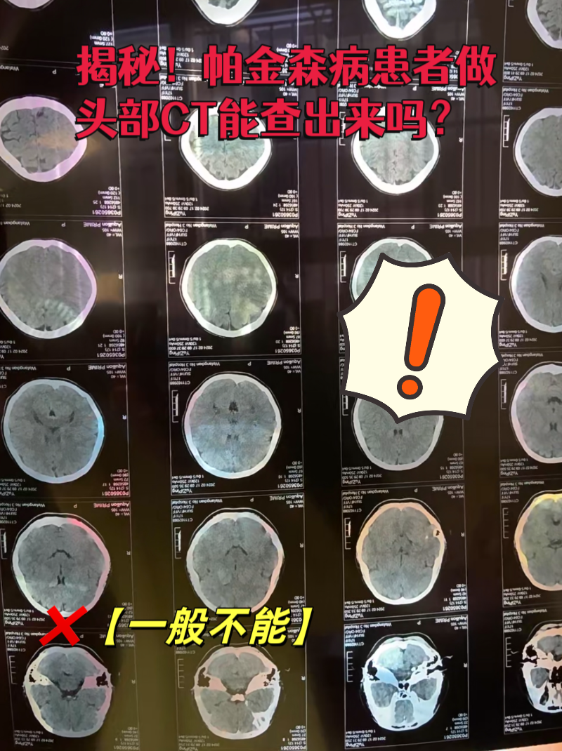 帕金森病患者做头部ct能查出来吗?