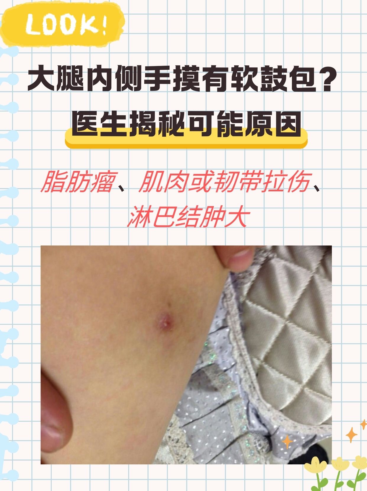 大腿根内侧摸到疙瘩,可能是淋巴结肿大,也可能是脂肪瘤