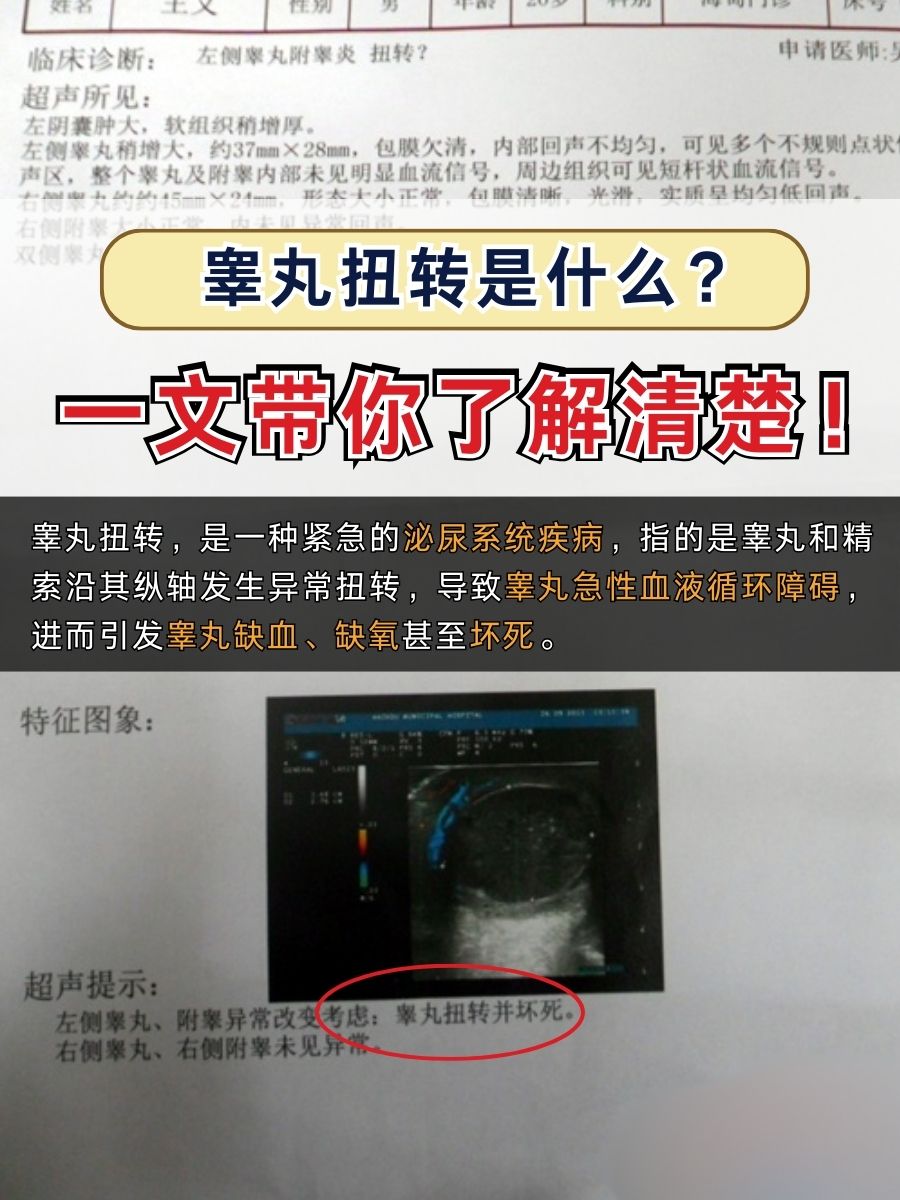 睾丸扭转,指的是睾丸和精索沿其纵轴发生异常扭转,这种扭转通常会