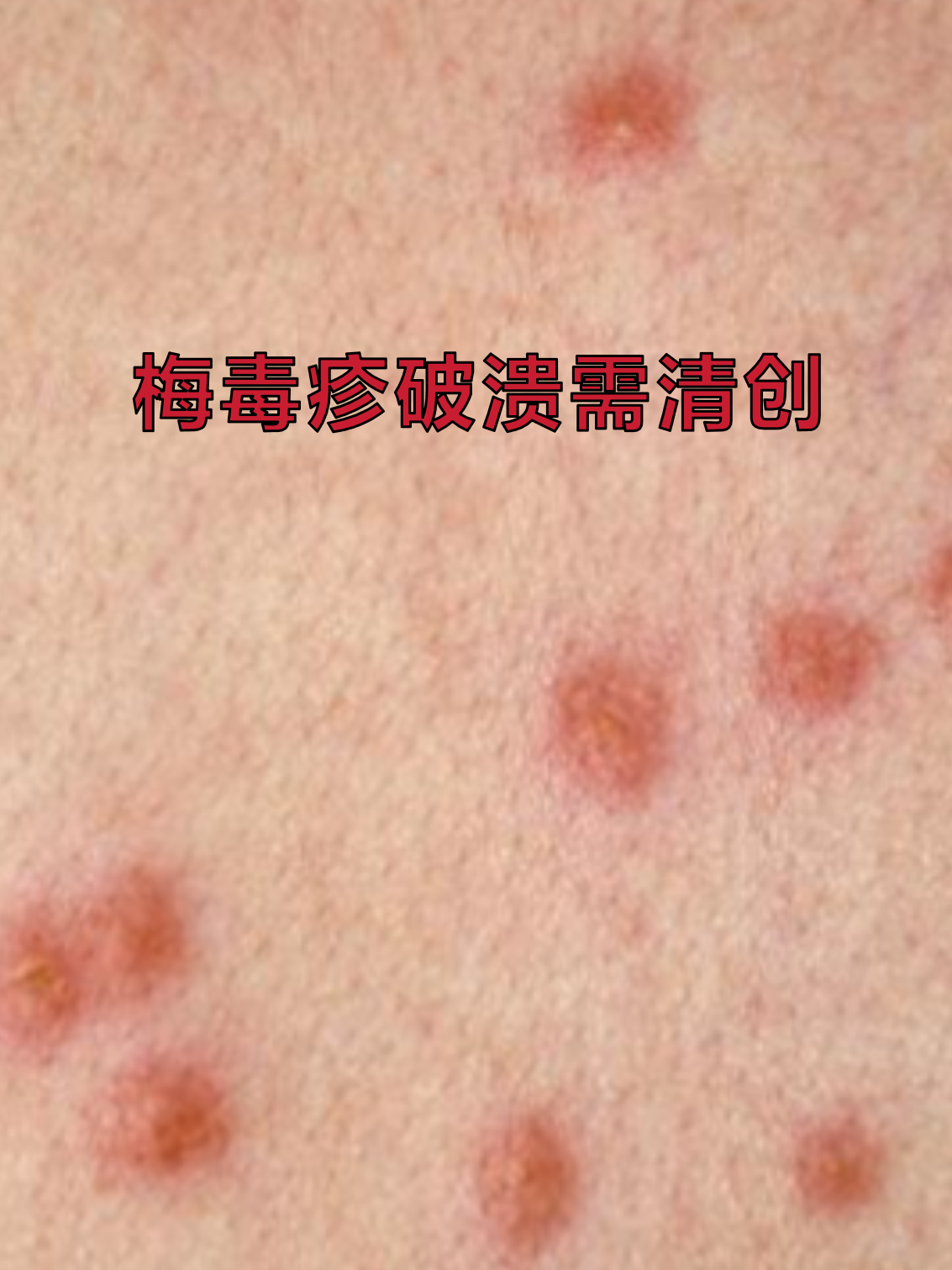 这种皮肤表现是二期梅毒的典型特征,正确处理能避免感染加重和瘢痕