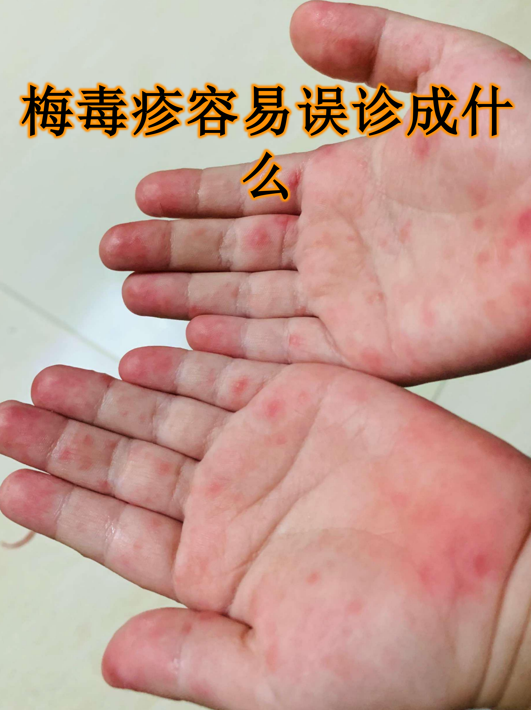 梅毒疹容易误诊成什么