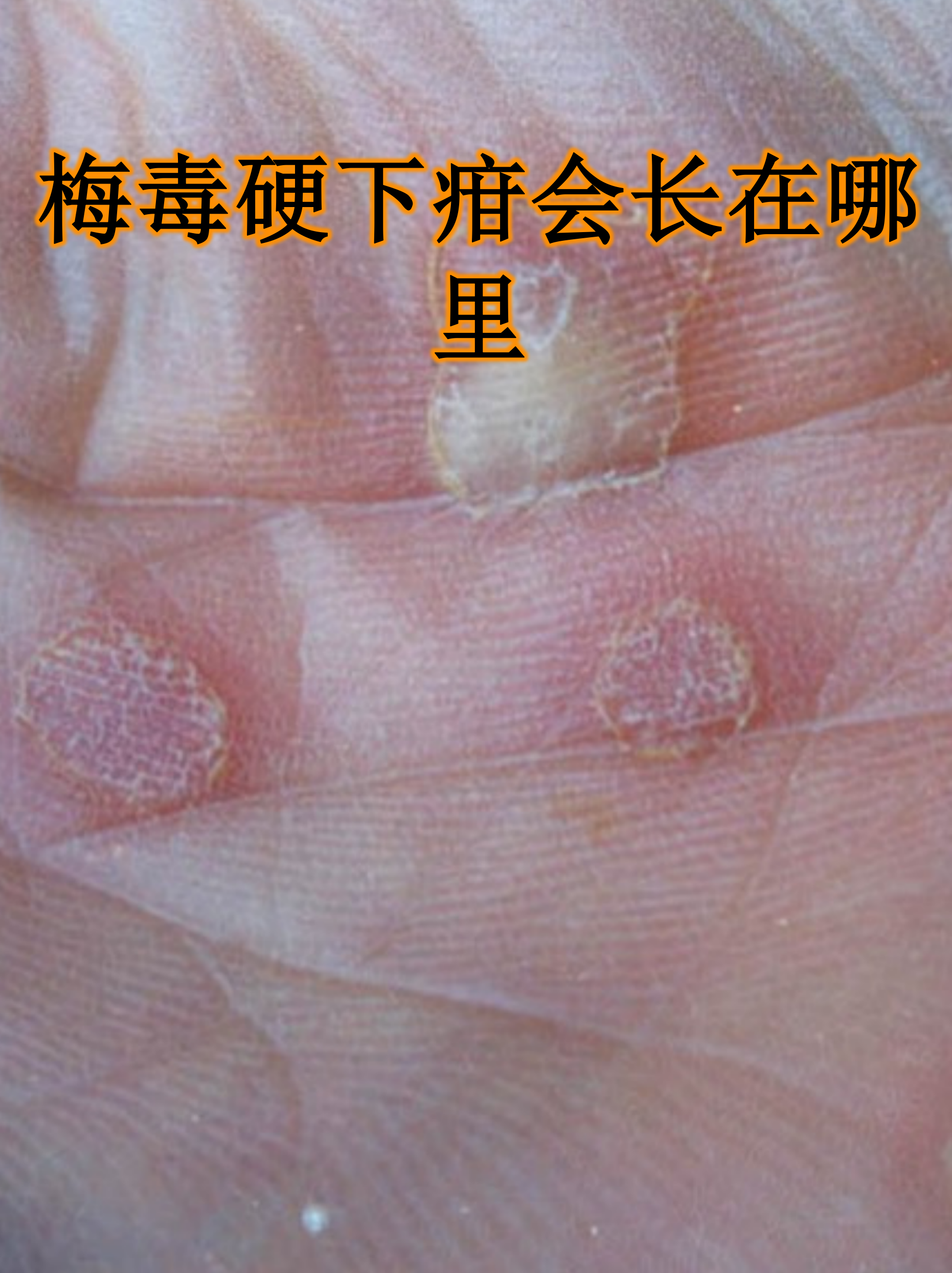 梅毒硬下疳是梅毒早期的典型表现,这种无痛性