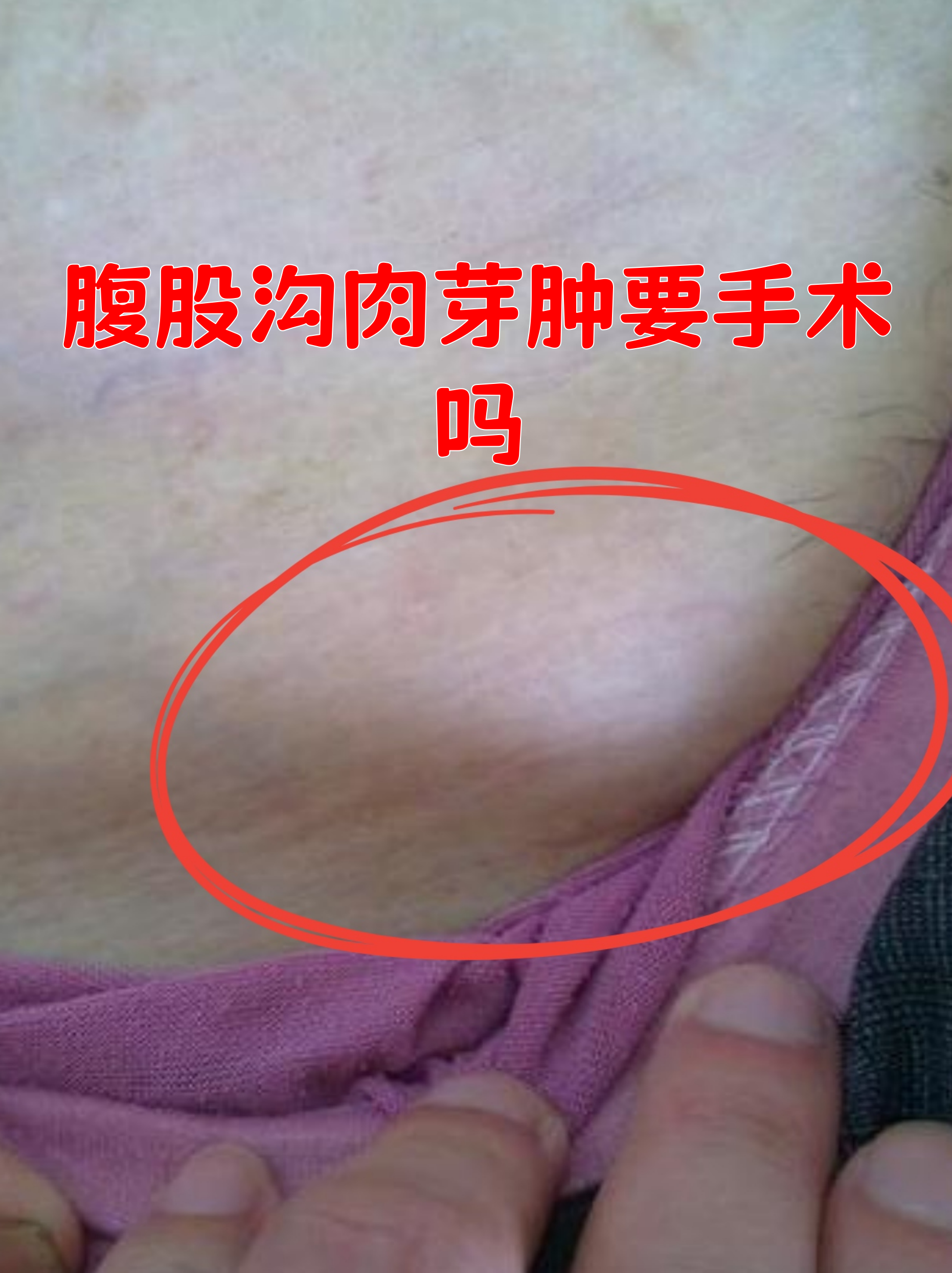 腹股沟肉芽肿要手术吗