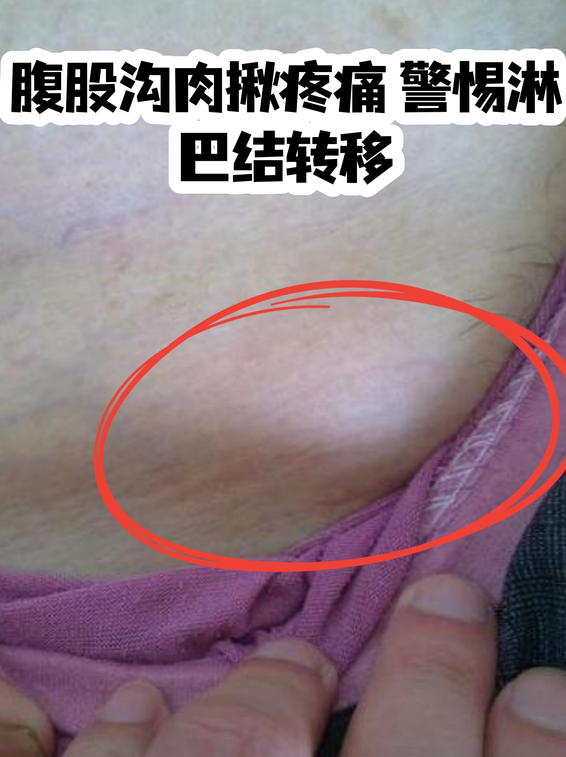 腹股沟肉揪疼痛 警惕淋巴结转移