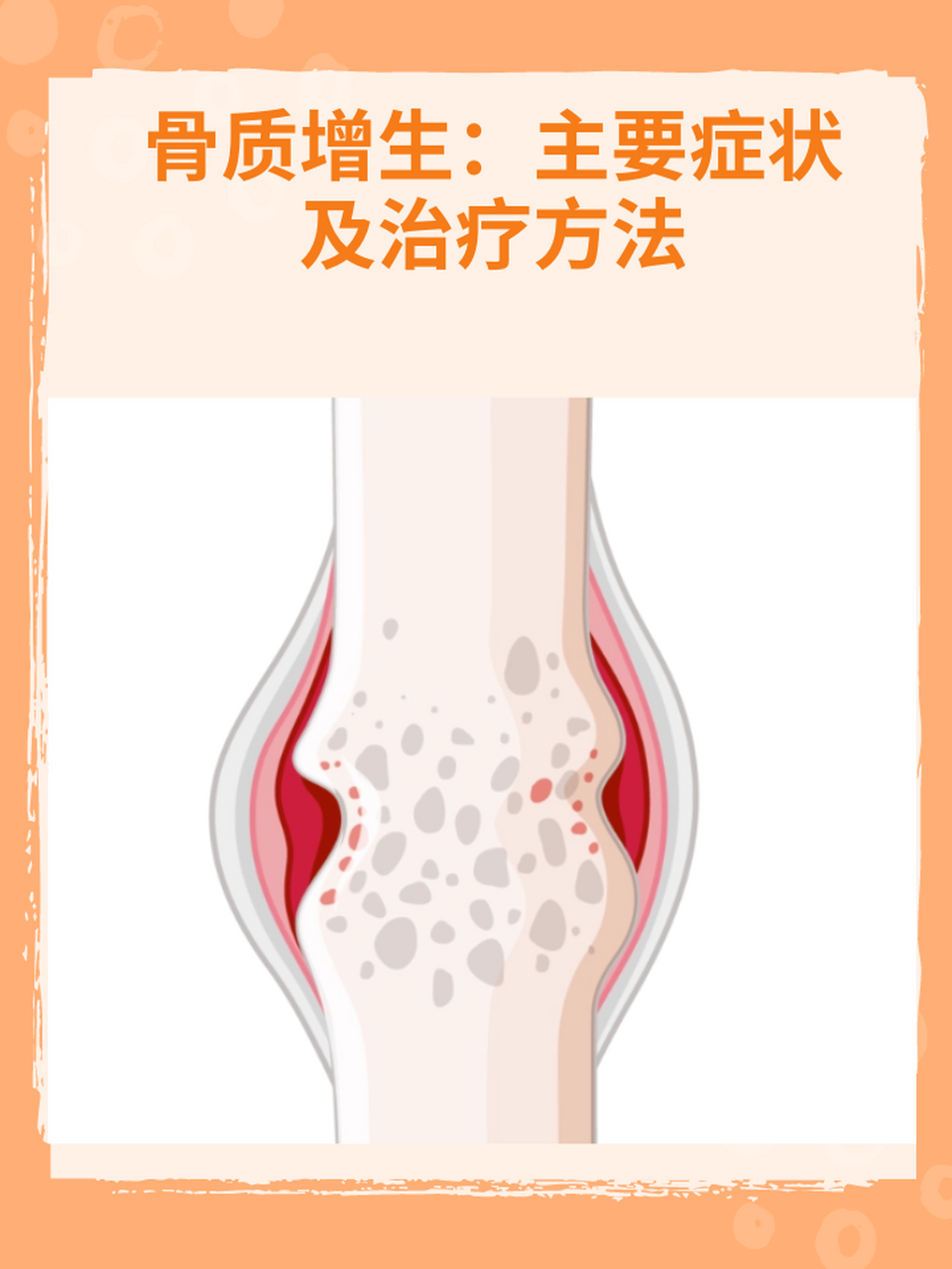 97骨质增生:主要症状及治疗方法 骨质增生,也称为骨刺,是一种常见的