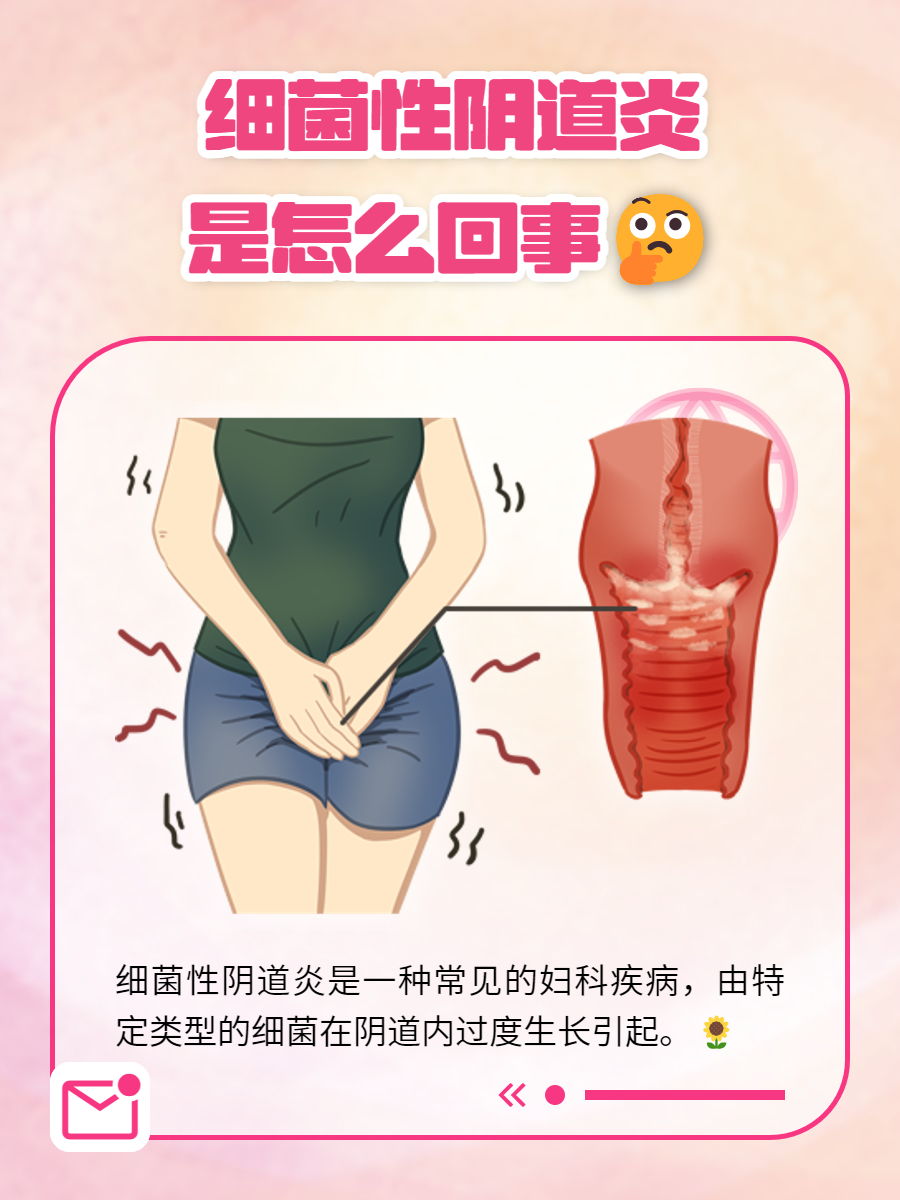 细菌性阴道炎是一种常见的妇科疾病,由特定类型的细菌