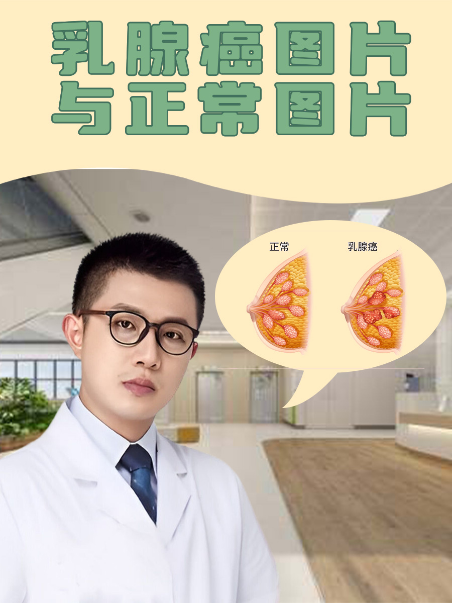 男性乳腺癌位置图图片