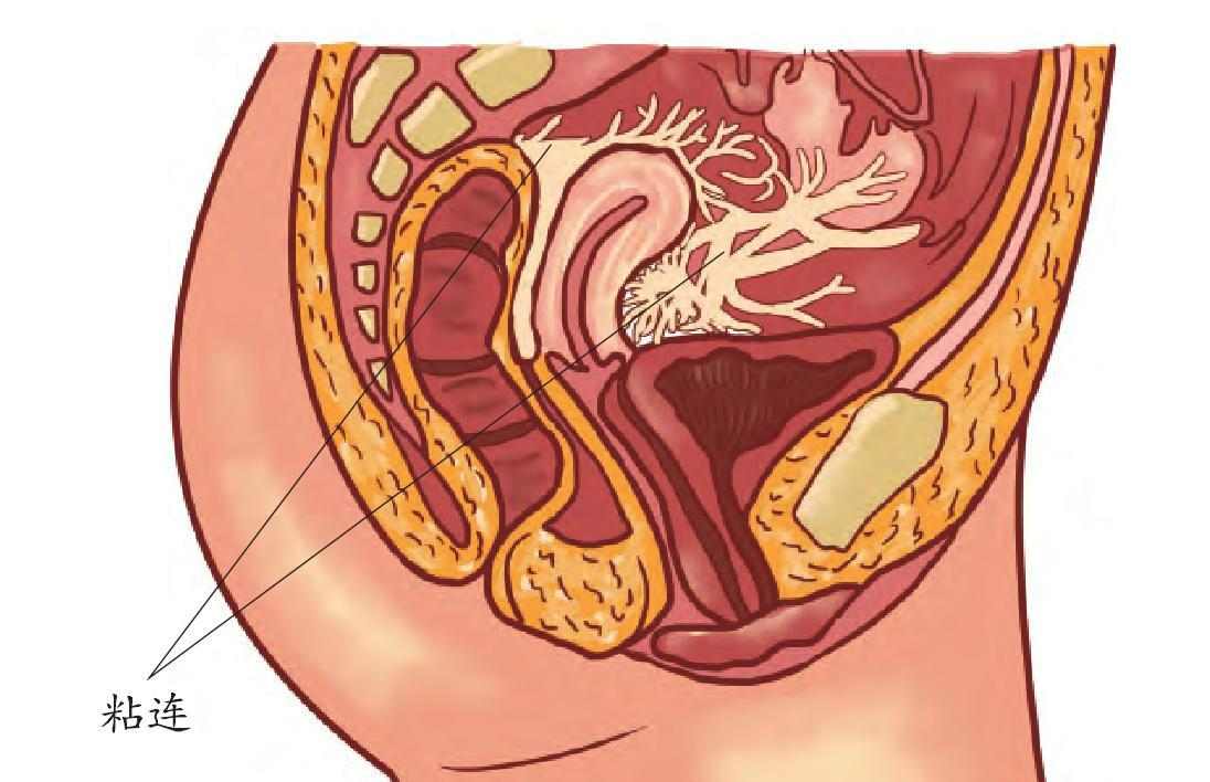 宫腔粘连对女性生育和生活质量会造成一定影响