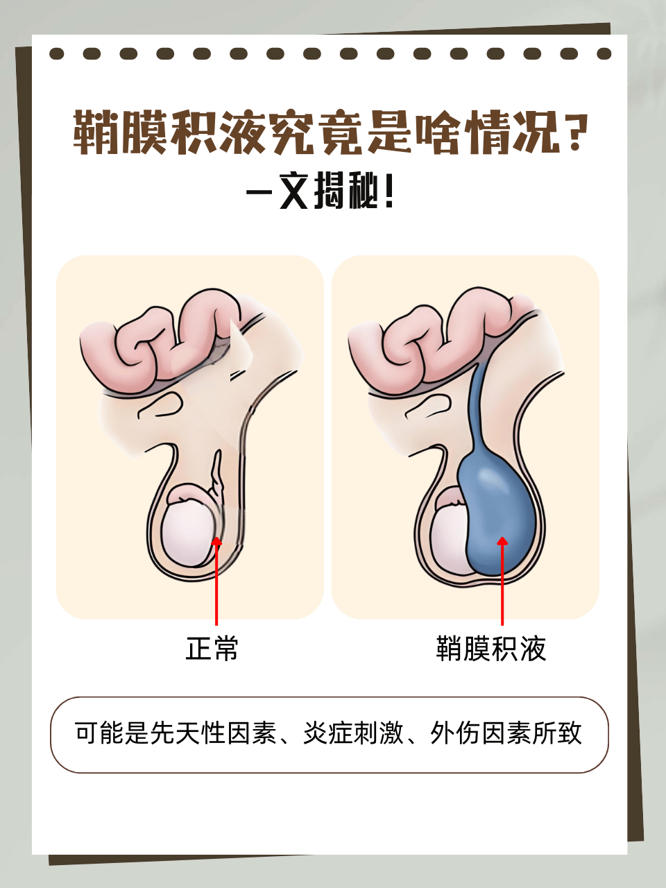 鞘膜积液其实就是鞘膜腔内积聚了过多液体