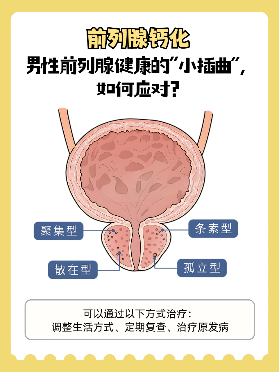 前列腺钙化