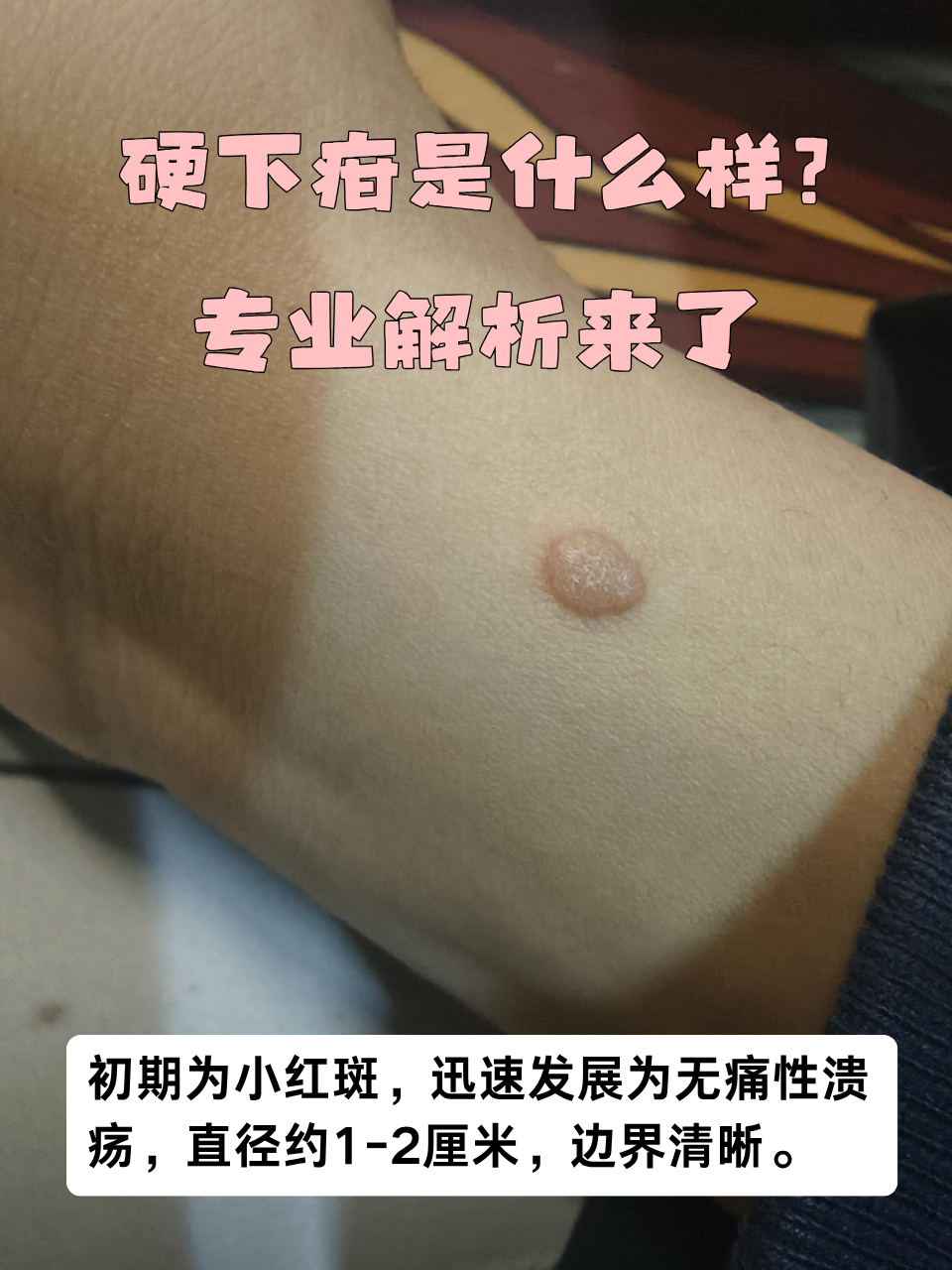 其中硬下疳作为梅毒的典型症状,究竟是什么样的?