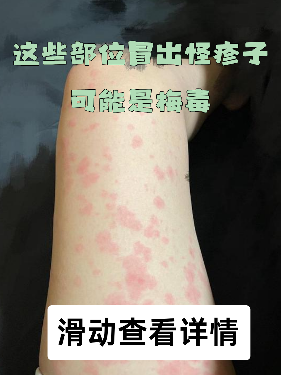 这些部位冒出怪疹子,可能是梅毒