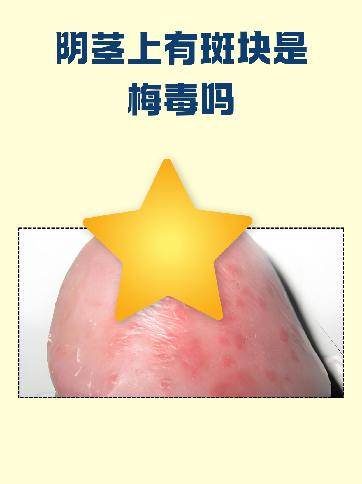 最近有朋友咨询阴茎皮肤出现斑块的问题,担心与梅毒有关