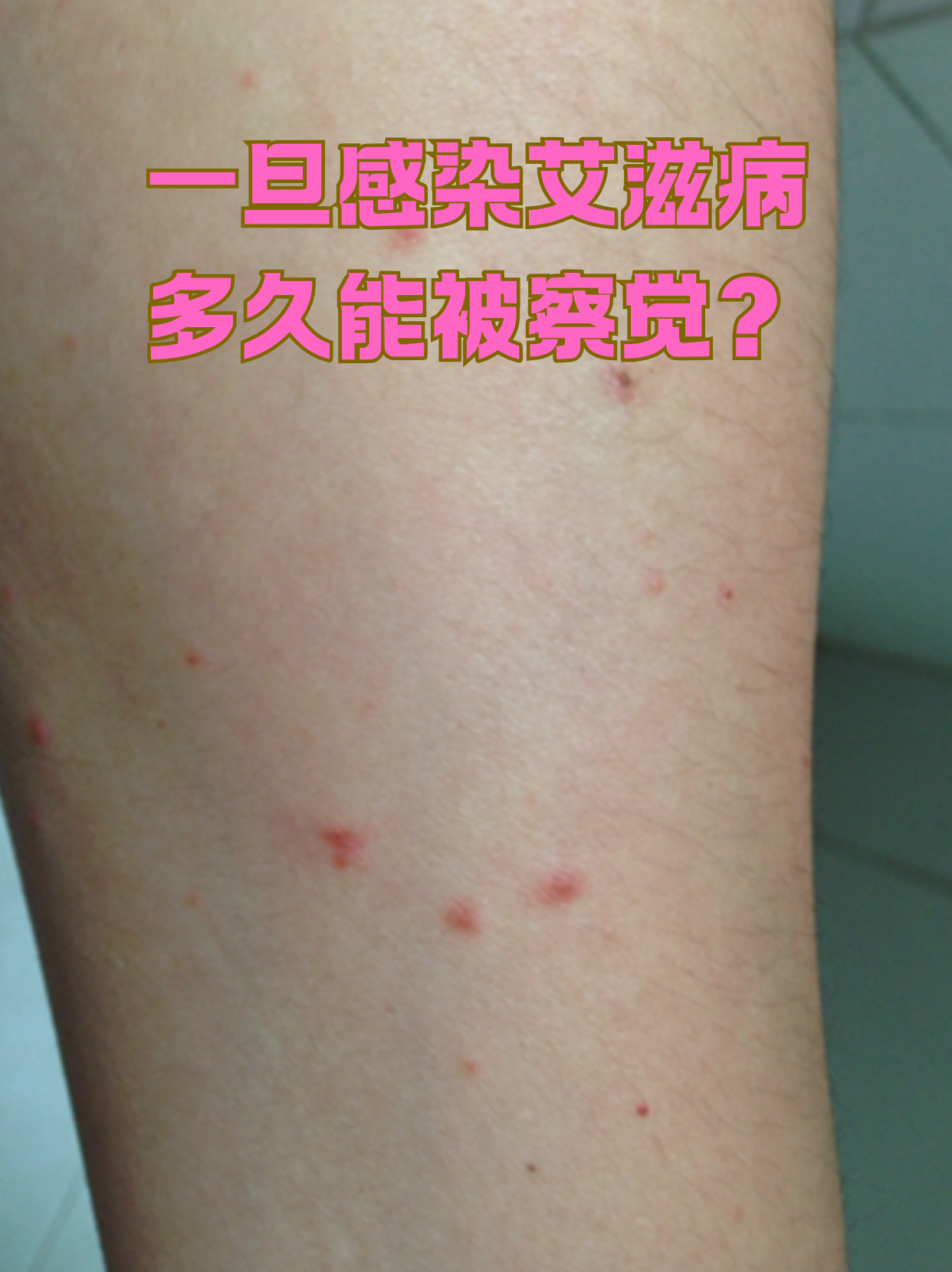 艾滋病的潜伏期差异较大,从感染到出现症状可能间隔数月至数年