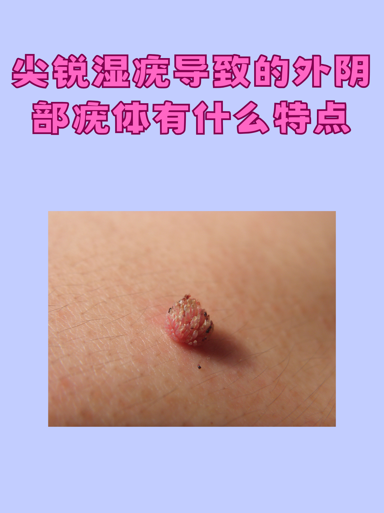 尖锐疣体变黑是为什么