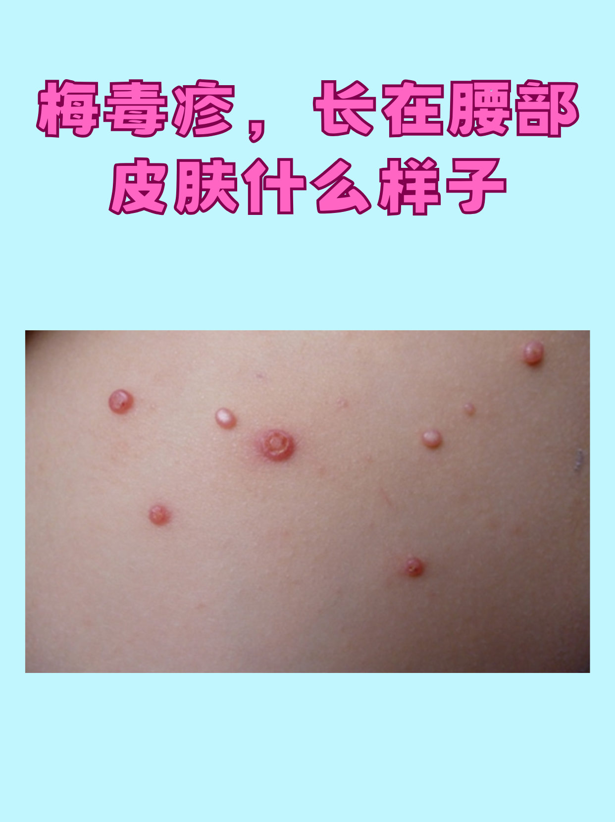 梅毒疹,长在腰部皮肤什么样子