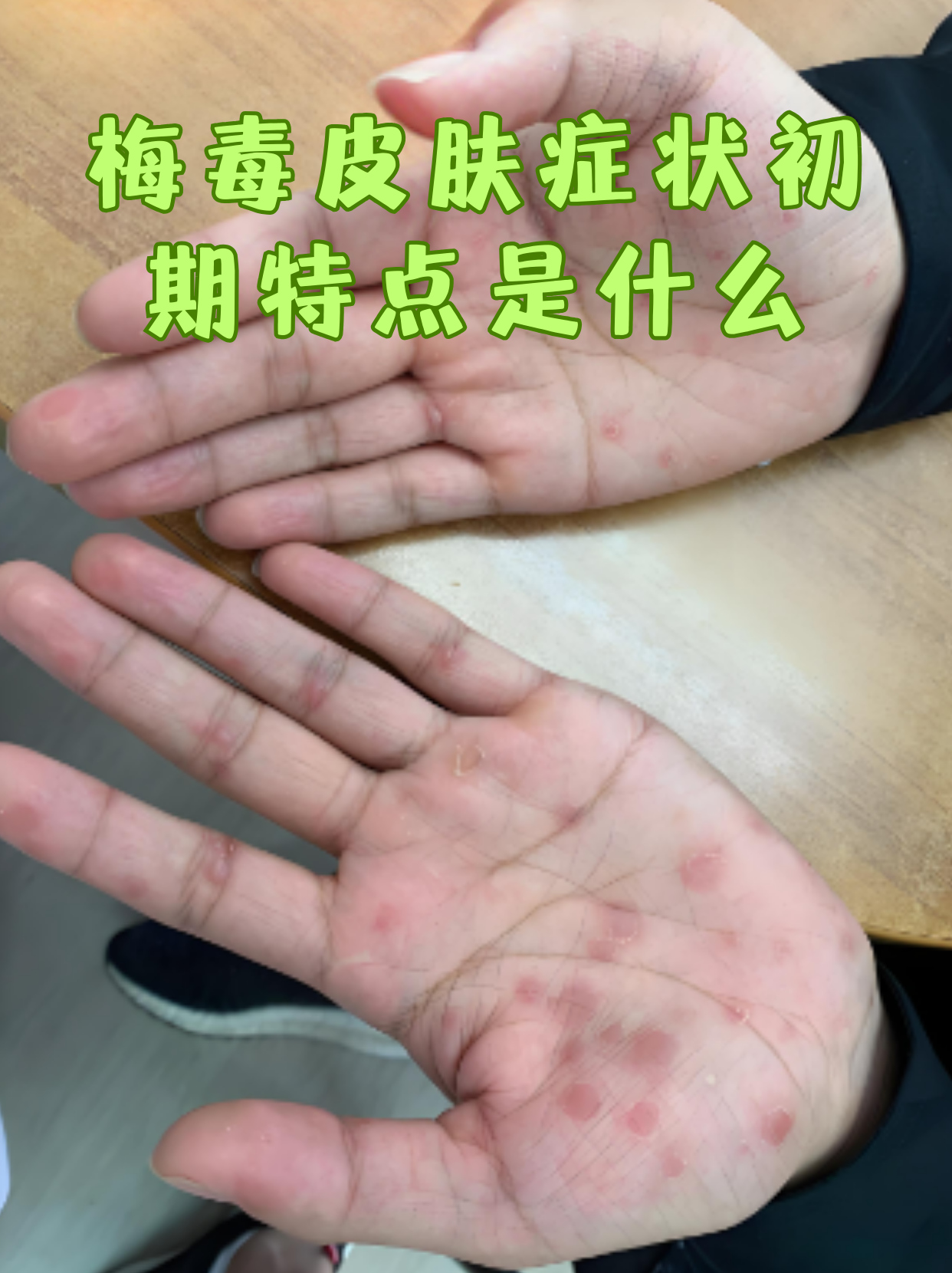 梅毒皮肤症状初期特点是什么