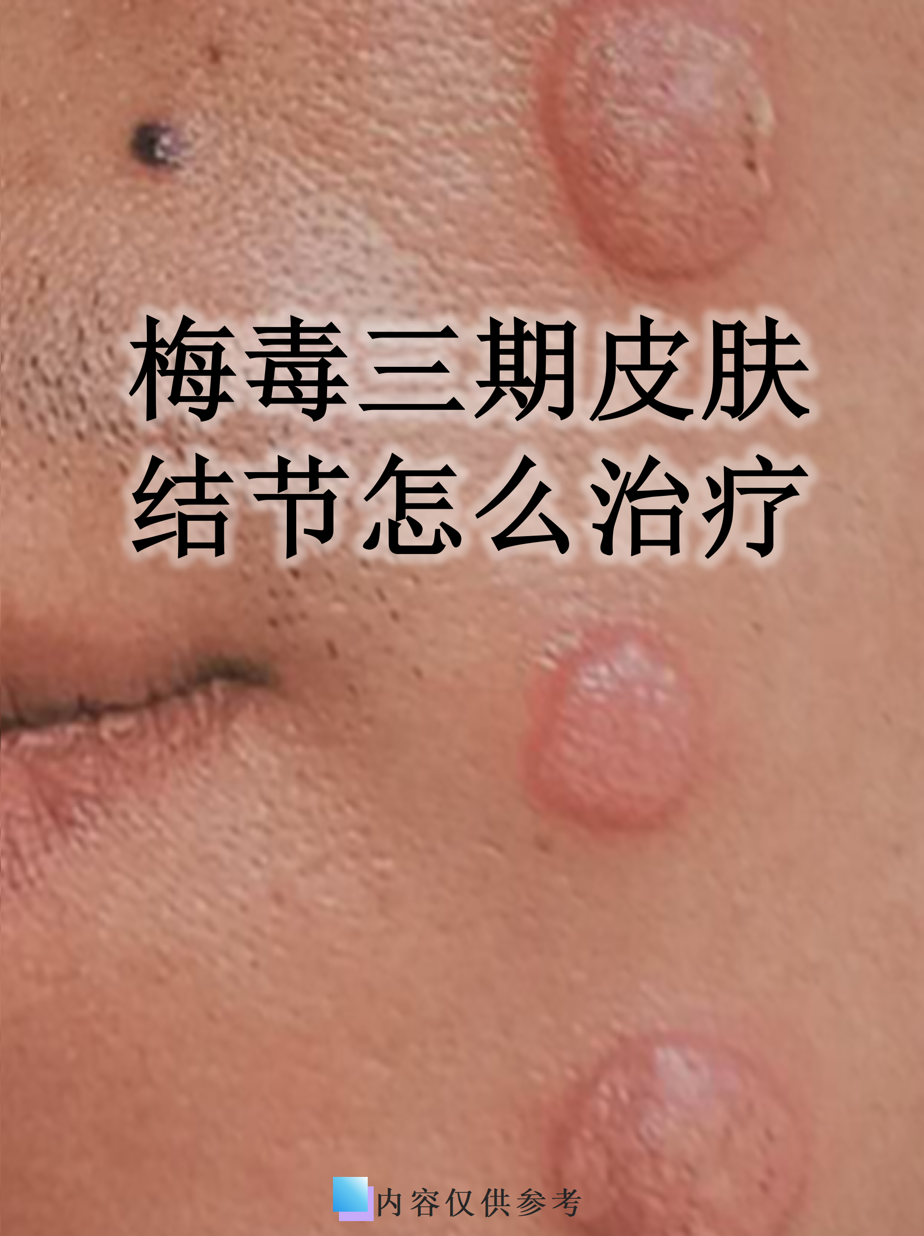 梅毒三期皮肤结节怎么治疗