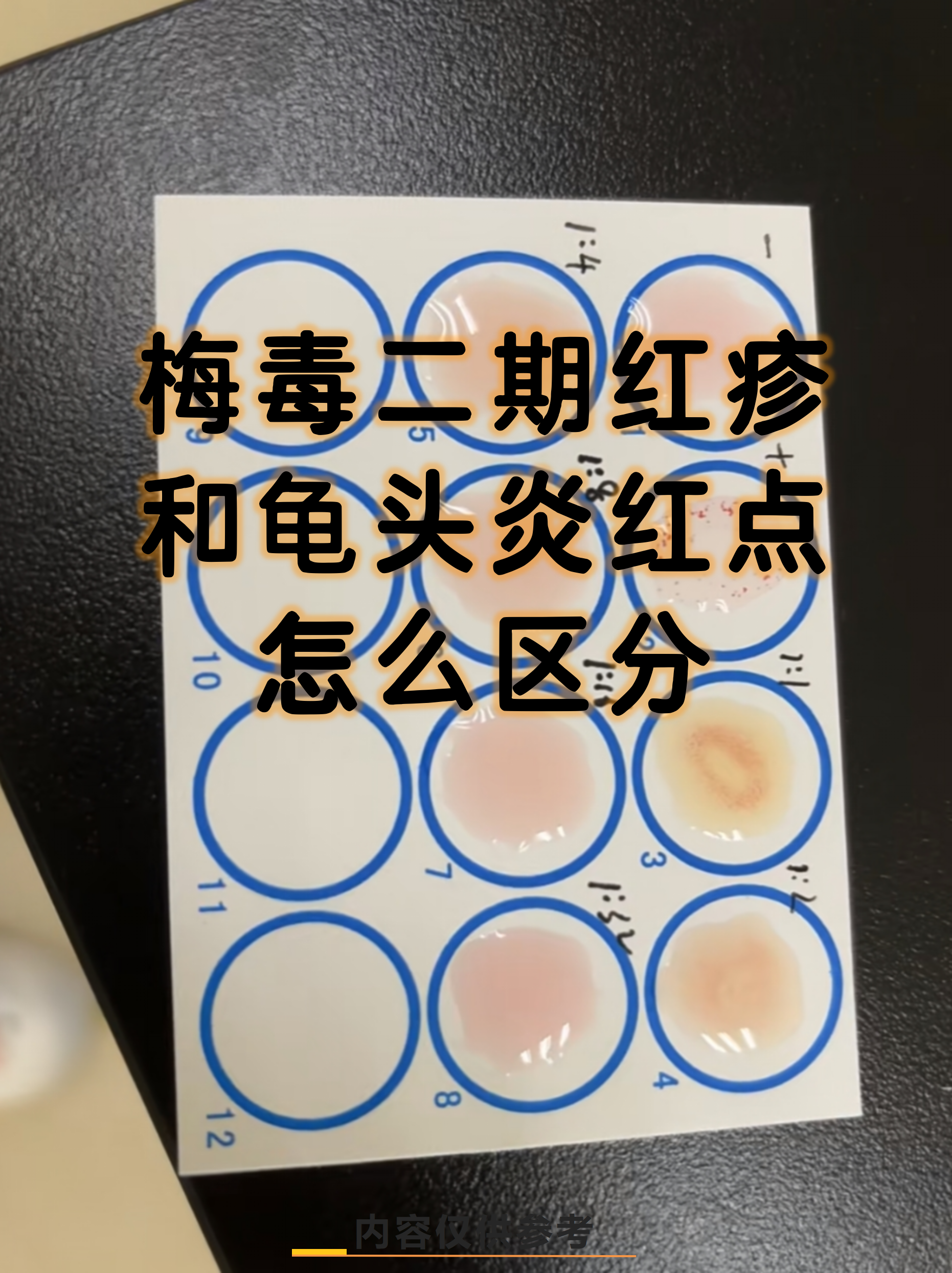 梅毒二期红疹和龟头炎红点怎么区分