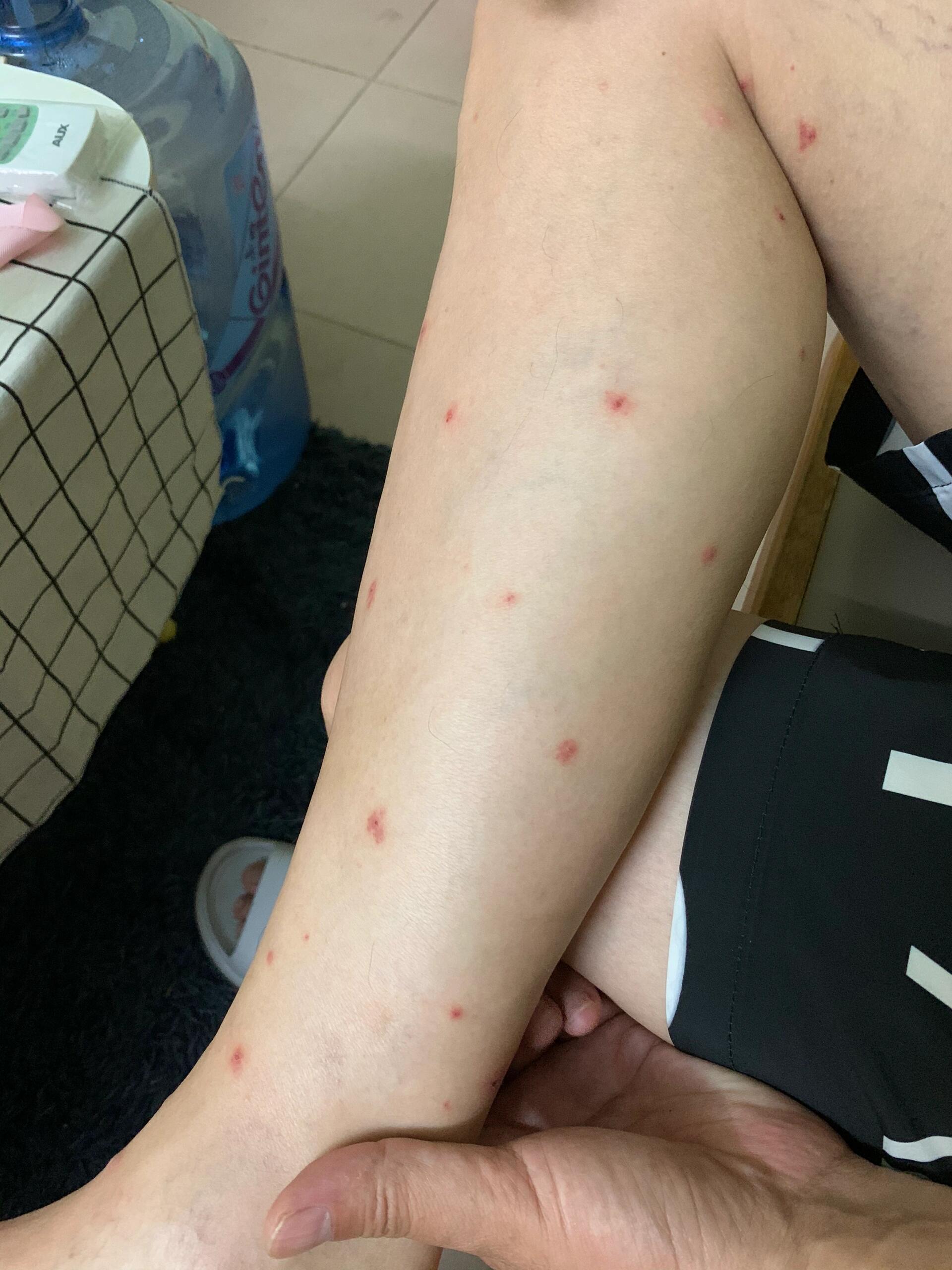 hpv早期感染阶段通常无明显症状,容易延误干预