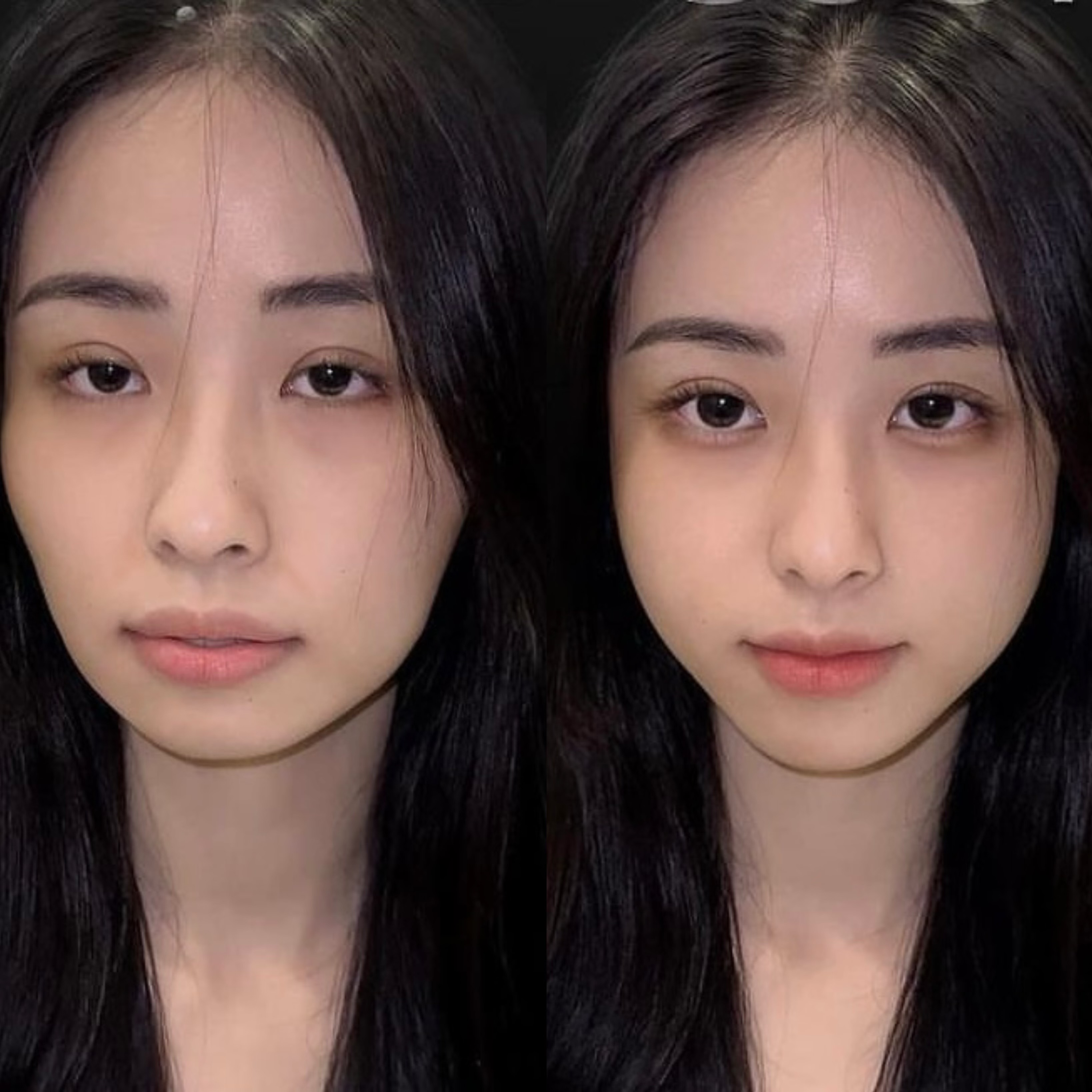 前后对比面部变美生孩子前后脸部图片脸变宽对比图36岁做面部提升前后