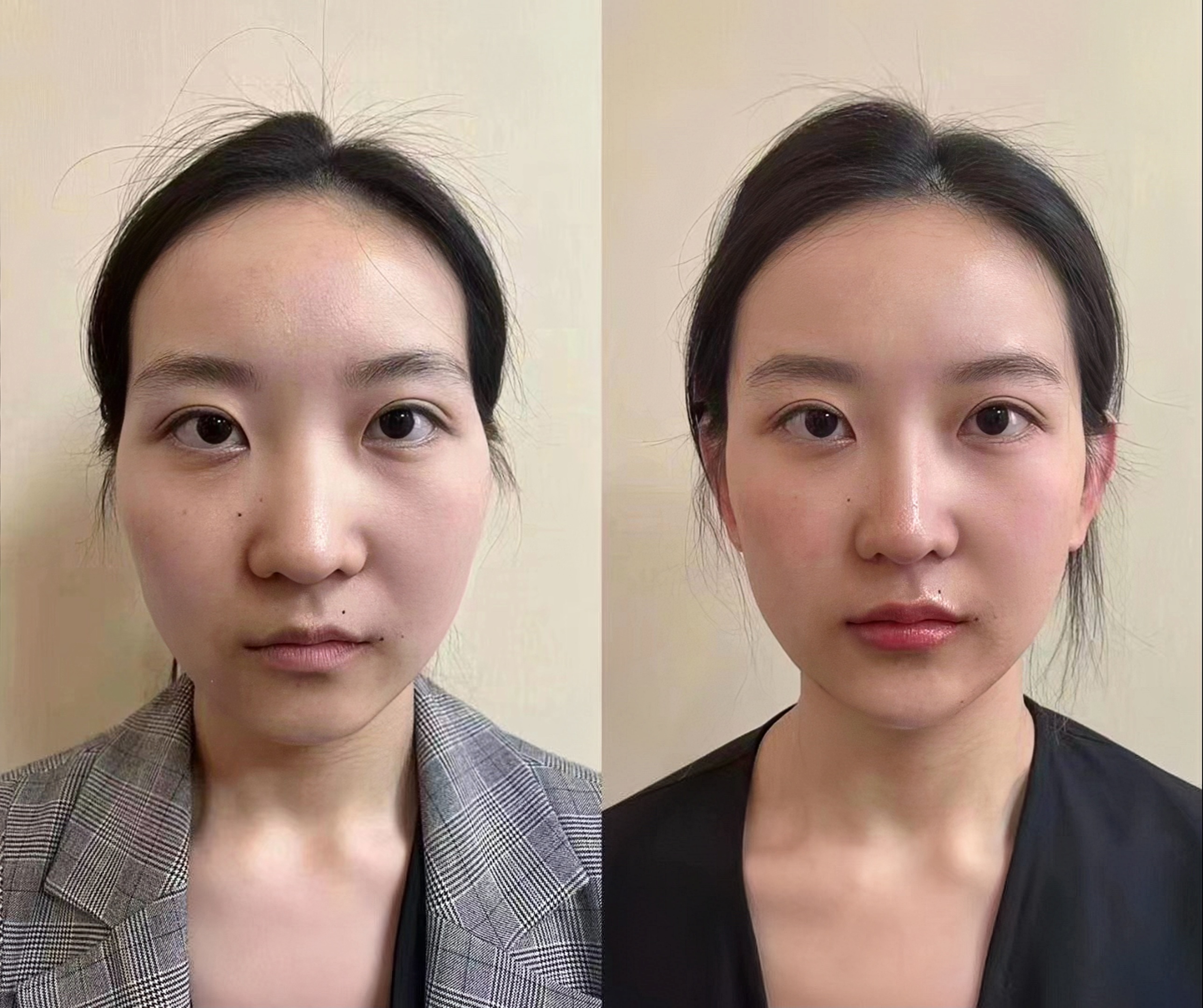 颧骨徒手矫正对比照抗衰老照片真人颧骨横张 对比图漫画脸修复对比图