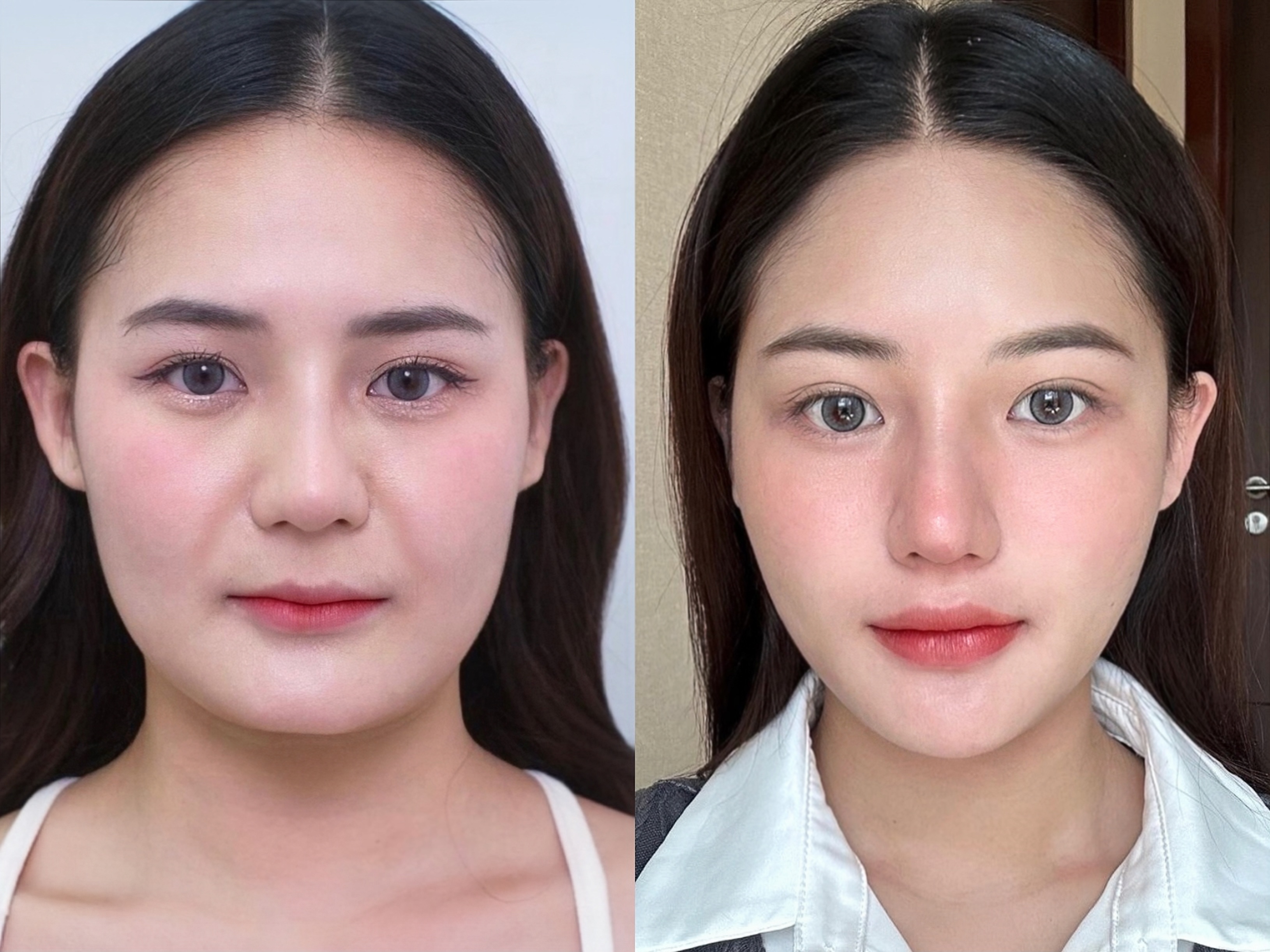 真实脸部松垮跟瘦了有没有关系面部馒化和紧致对比图片全脸提升对比图