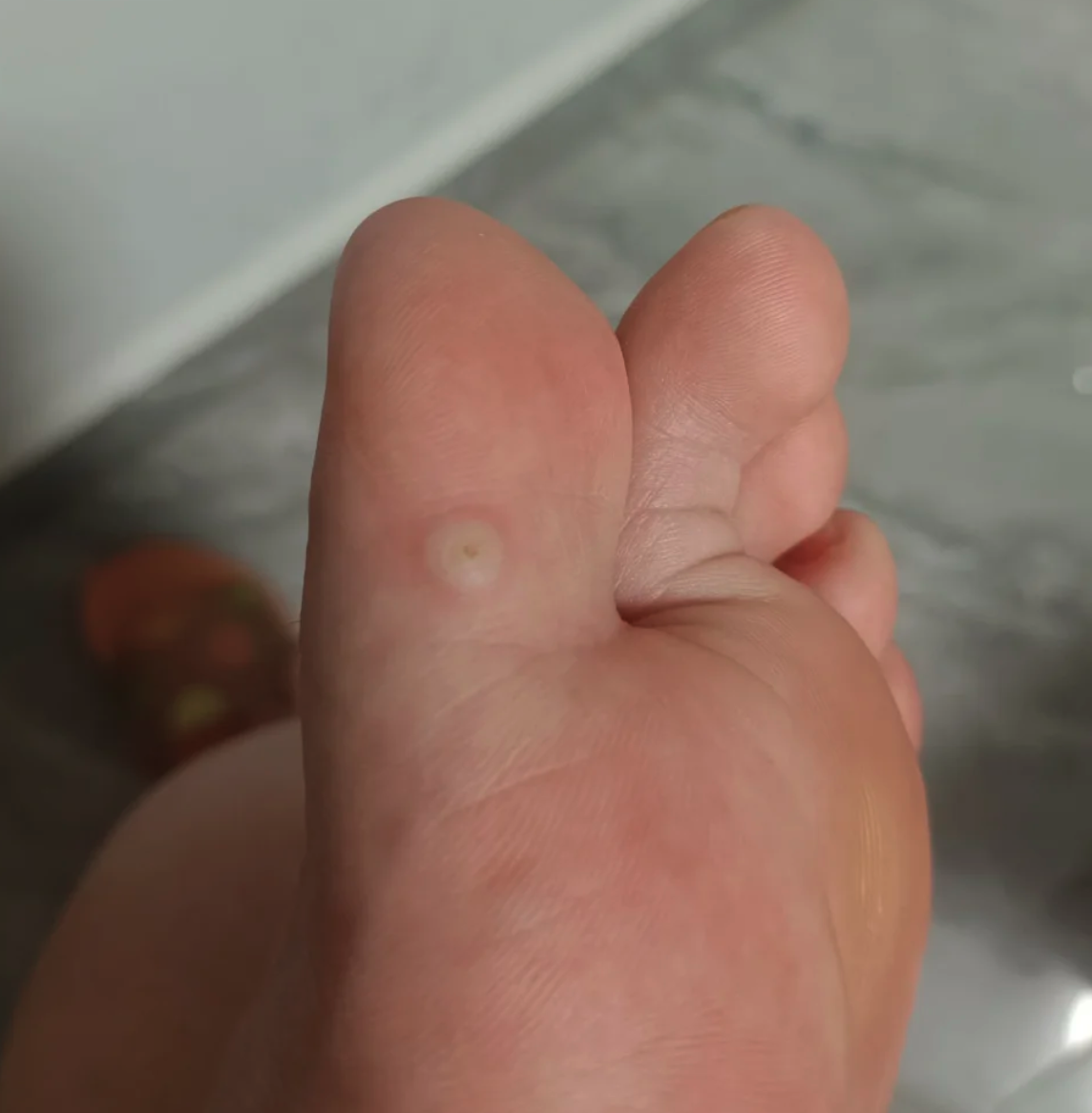 前期跖疣图片初期症状脚底长了跖疣初期图片脚底长跖疣早期图片