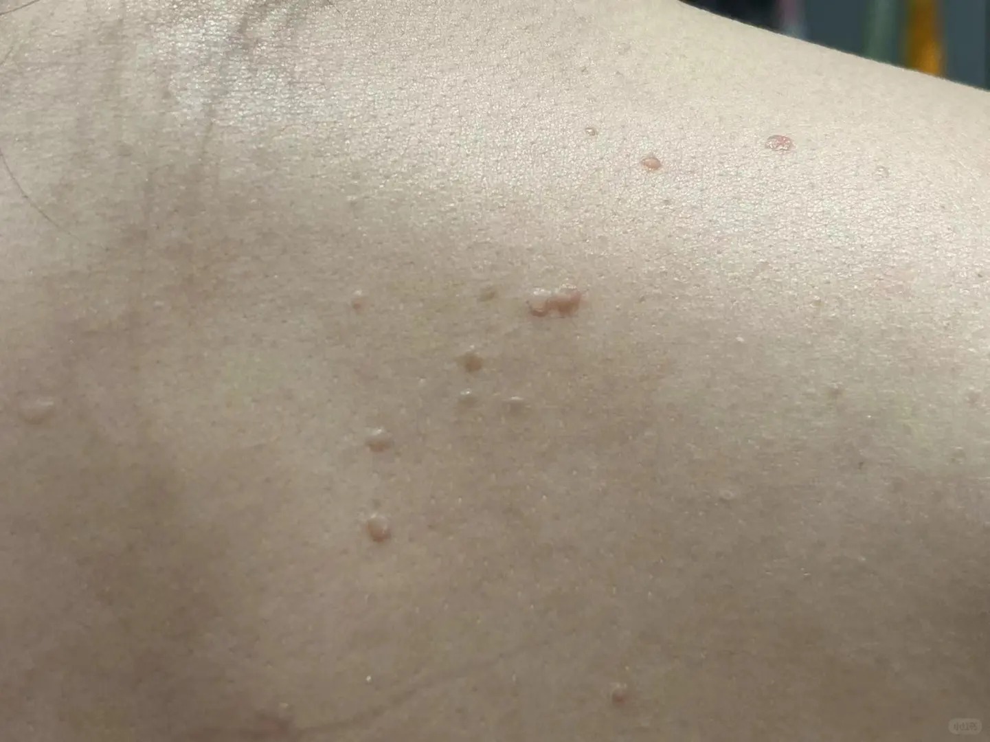 扁平疣确实有一定的自愈倾向,但具体情况因个体差异而异