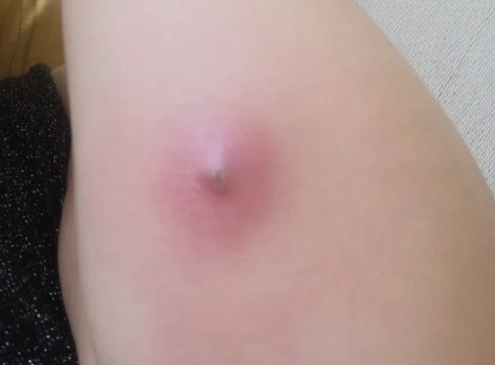 火疖子,在医学上称为疖,是一种毛囊深部及周围组织的急性化脓性炎症