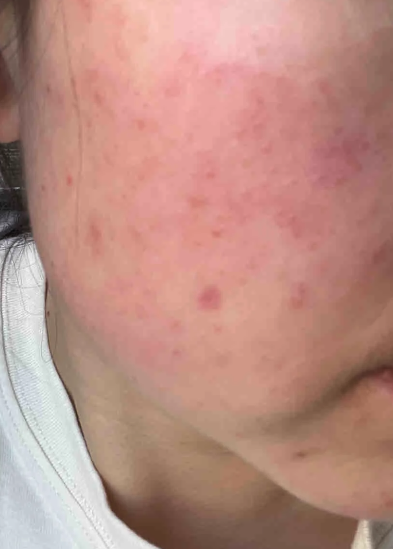 针对脸部过敏,最有效的药物选择需要根据患者的具体病情,过敏原因