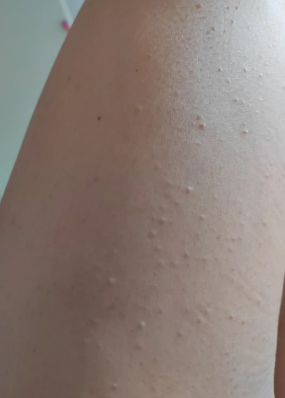 导致局部出现红色丘疹,同时还会伴有瘙痒,淮笸 毛囊炎腿部毛囊炎毛囊