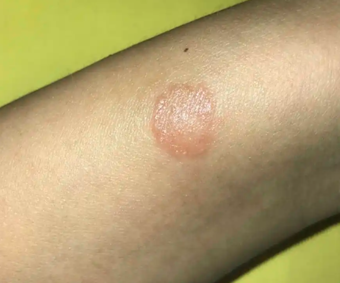 大钱疮,在皮肤科领域,通常指的是一种具有特定皮肤表现的皮肤疾病