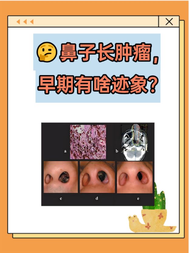 首先,我们要明白,鼻子长肿瘤包括良性和恶性肿瘤,早期发现和诊断队谮