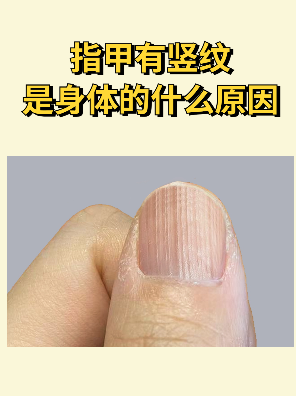 指甲有竖纹是身体的什么原因