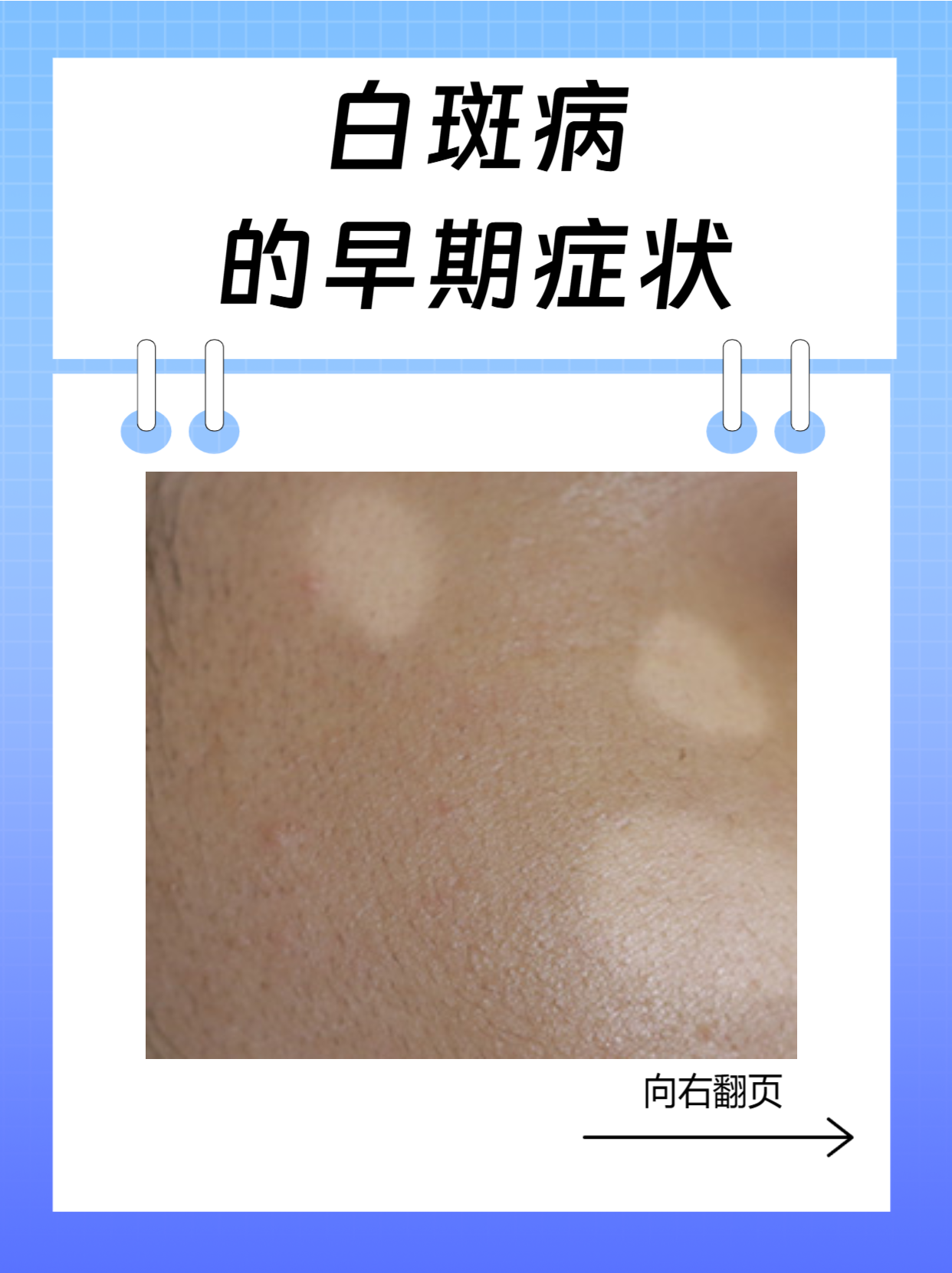 白斑病