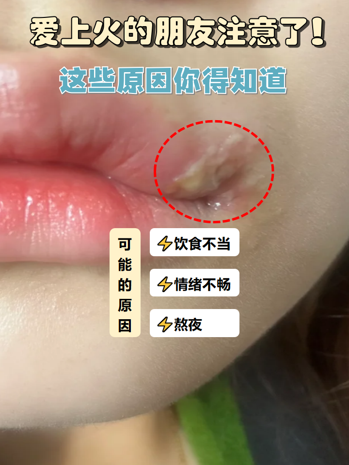 为什么老爱上火嘴唇起泡为什么在线 为什么老爱上火嘴唇起泡为什么在线