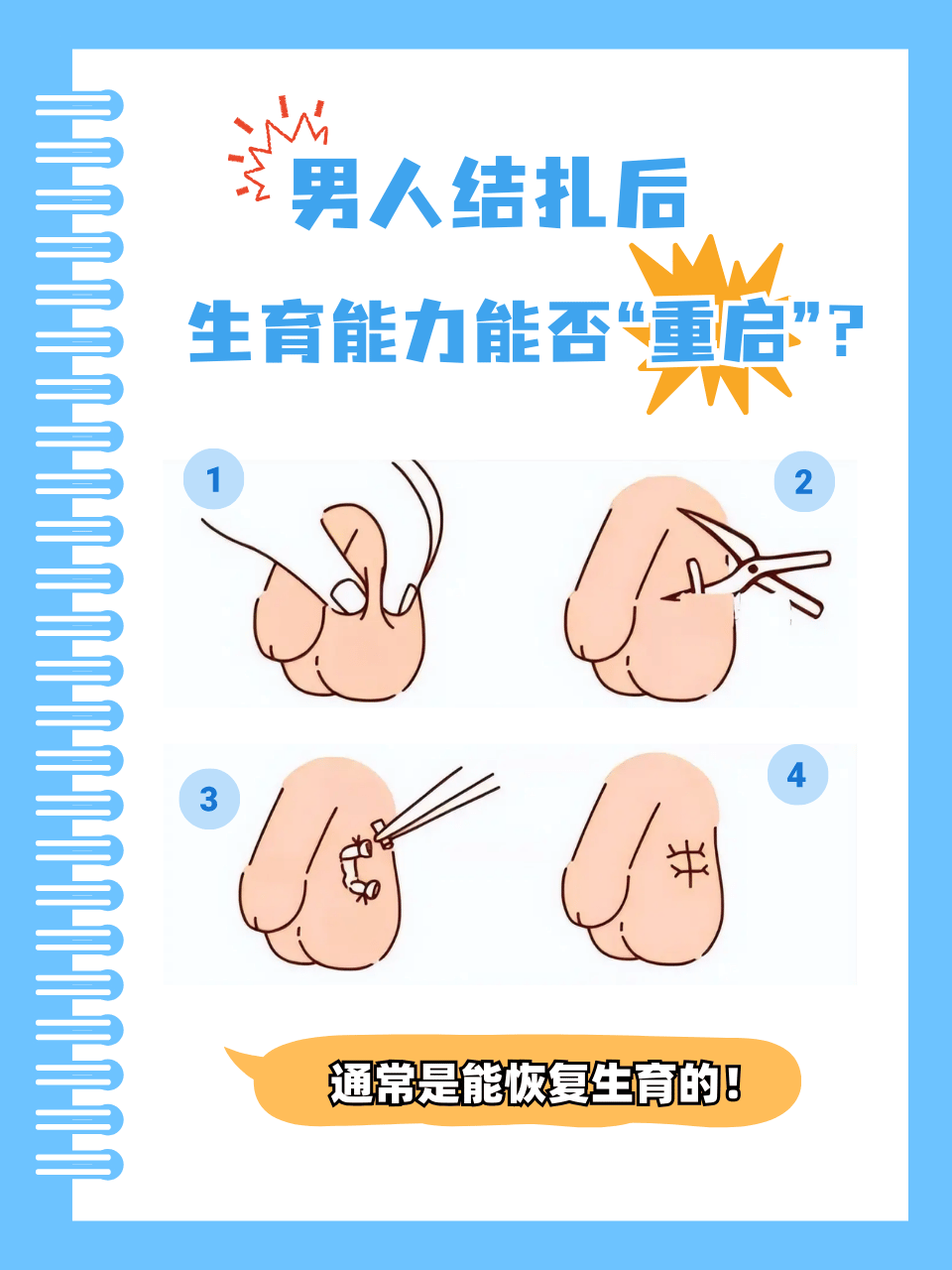 男人结扎,曾经被视为一劳永逸的避孕方法,不少男性为了家庭和伴侣