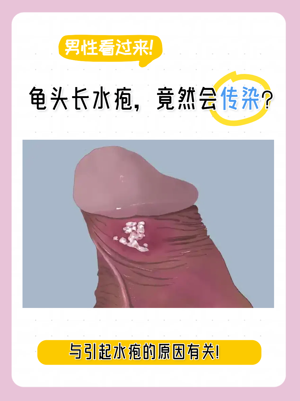 龟头长水疱,竟然会传染?
