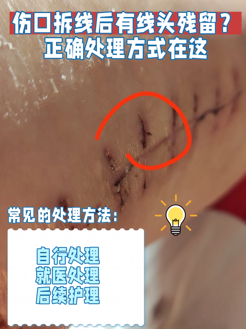 伤口冒线头出来怎么办可吸收线线头图片拆完线有线头钻出来小手术线没