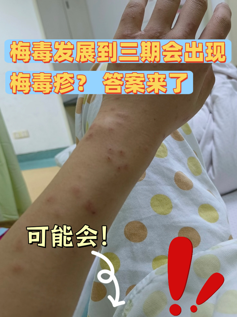 答案来了  确诊三期梅毒后,很多人担心身上会不会冒出梅毒疹