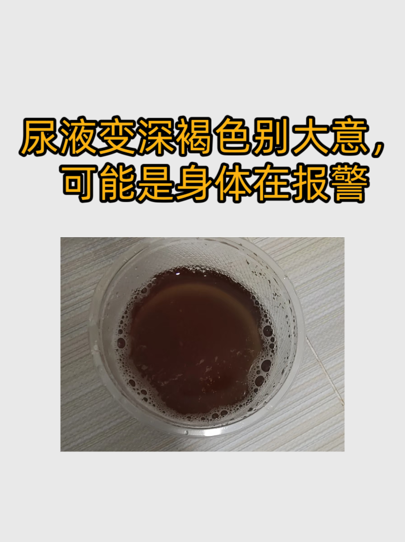尿液变深褐色别大意,可能是身体在报警