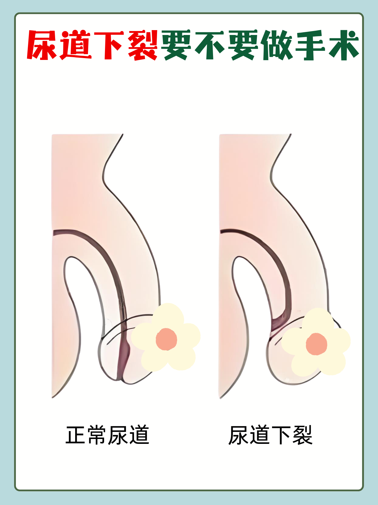 尿道下裂要不要做手术