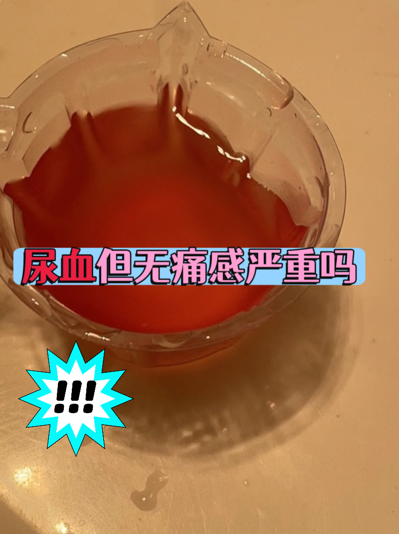 夏天发现尿液突然变红却没有任何疼痛,很多人会