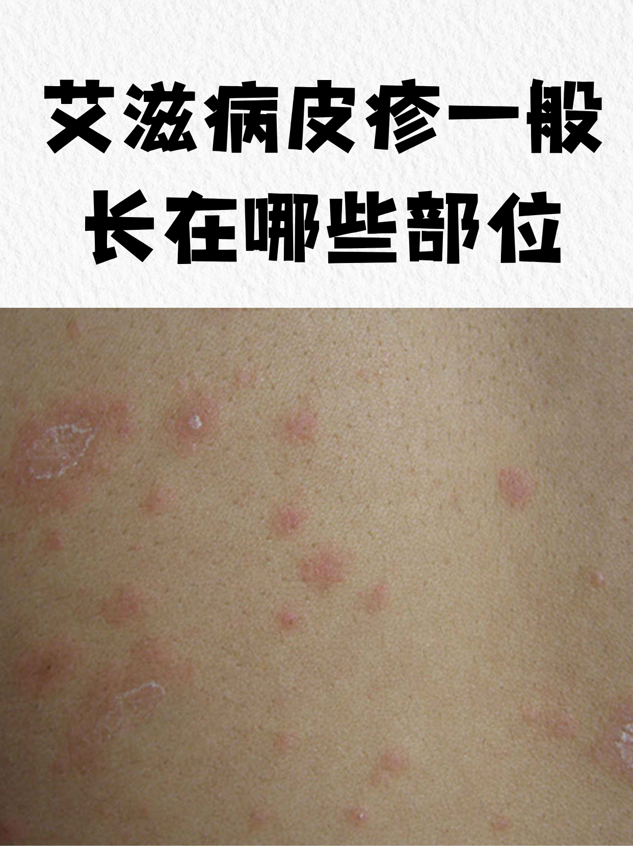 提到艾滋病感染,皮肤表现往往是早期信号之一,而皮疹作为常见症状,其