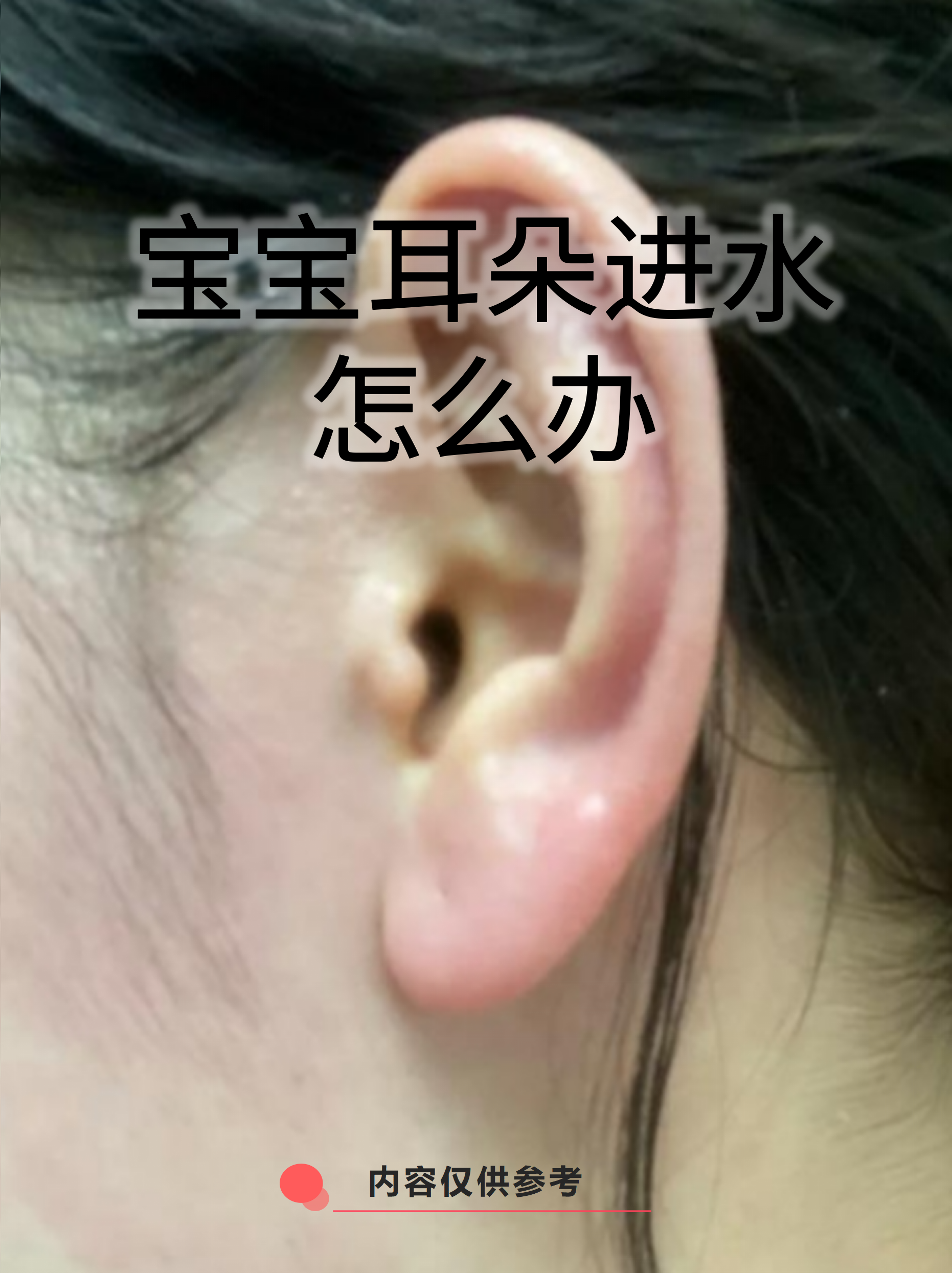 宝宝中耳炎初期图片(宝宝中耳炎初期图片大全)