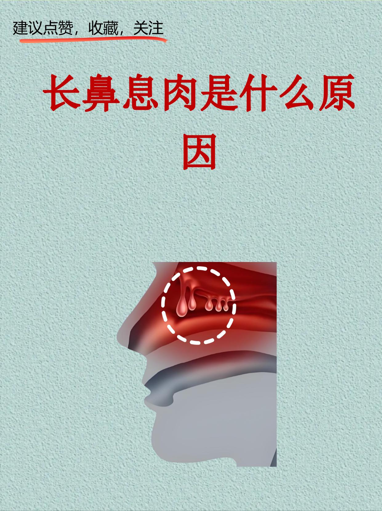 鼻息肉是鼻腔内常见的良性增生组织像葡萄串一